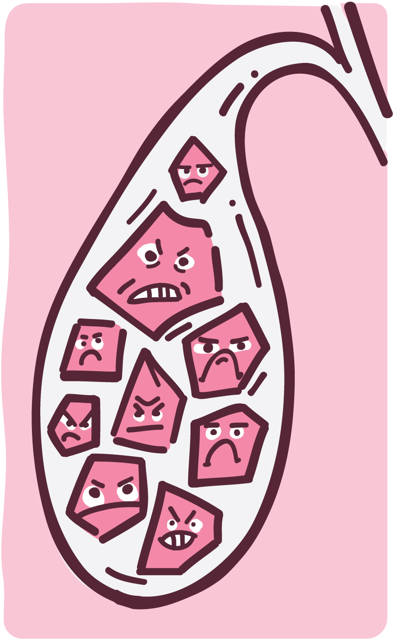 Illustration of gallstones inside a gallbladder.