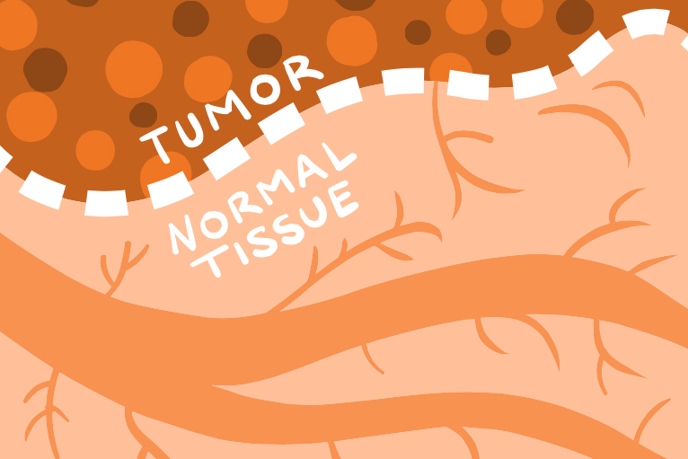 Illustration showing a clear line between tumor tissue and normal tissue.