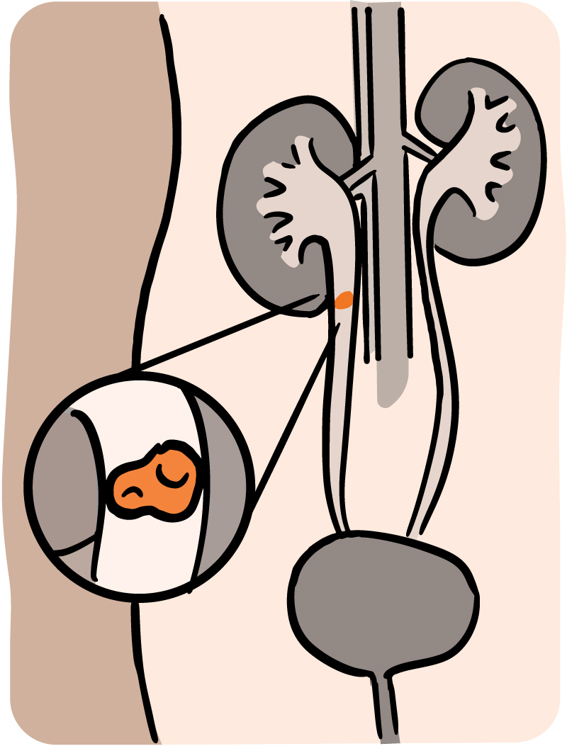 Illustration of a kidney stone in the urinary tract.