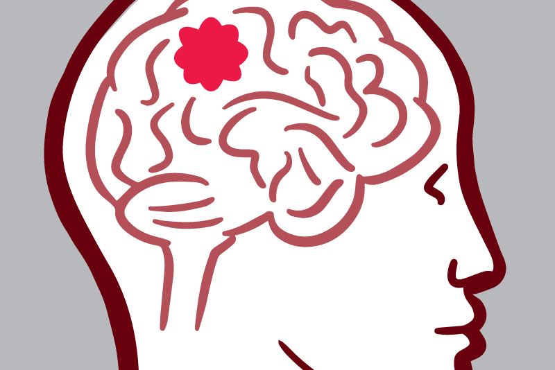 Illustration of a brain tumor.