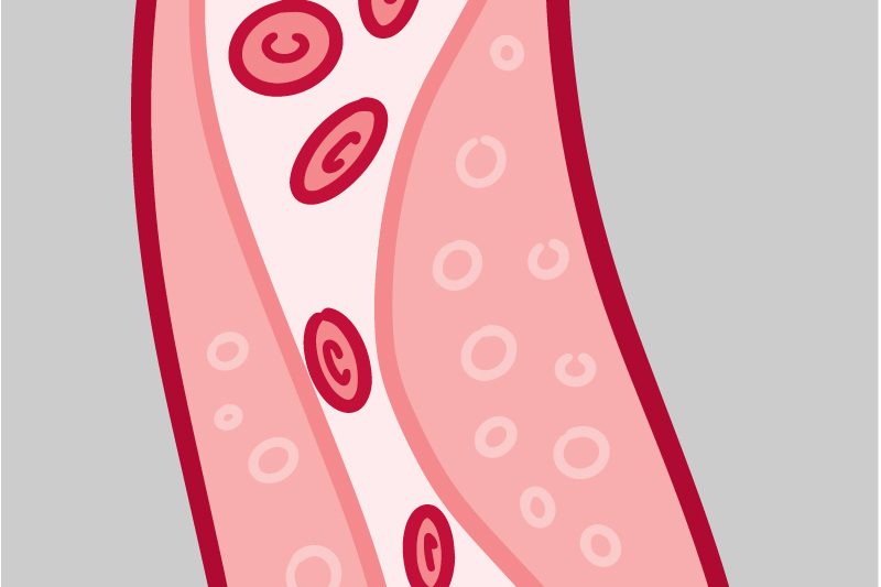 Illustration of a blood vessel with plaque buildup
