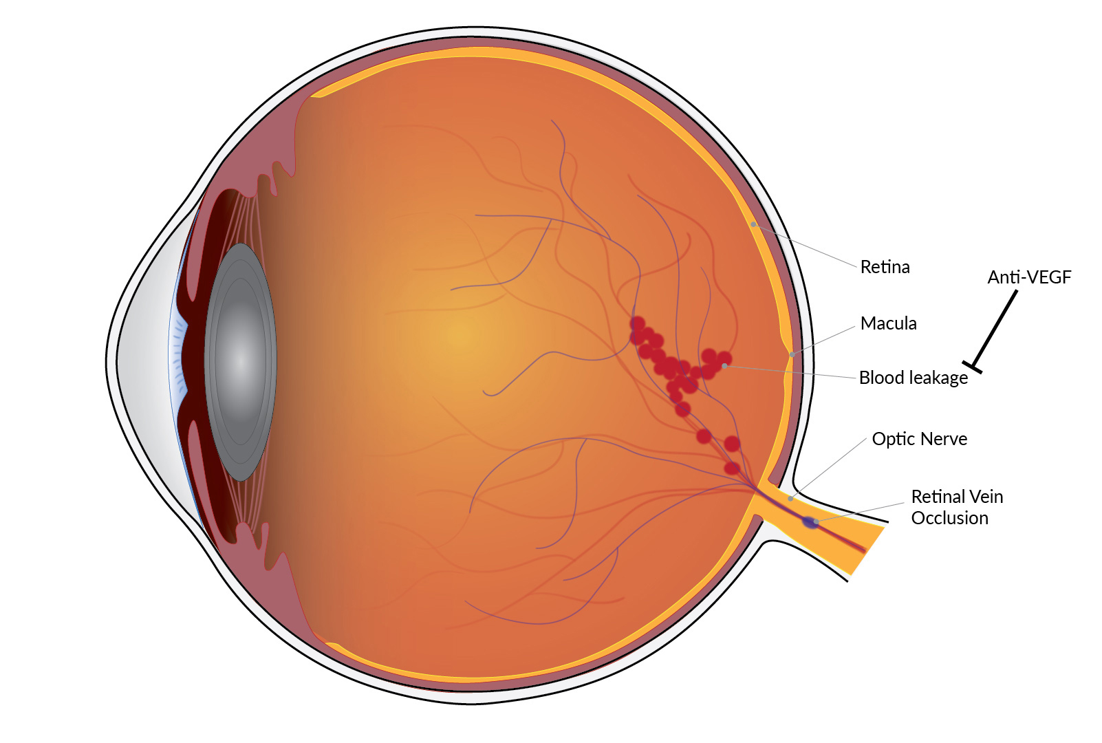 Diagram of an eye with a retinal vein occlusion