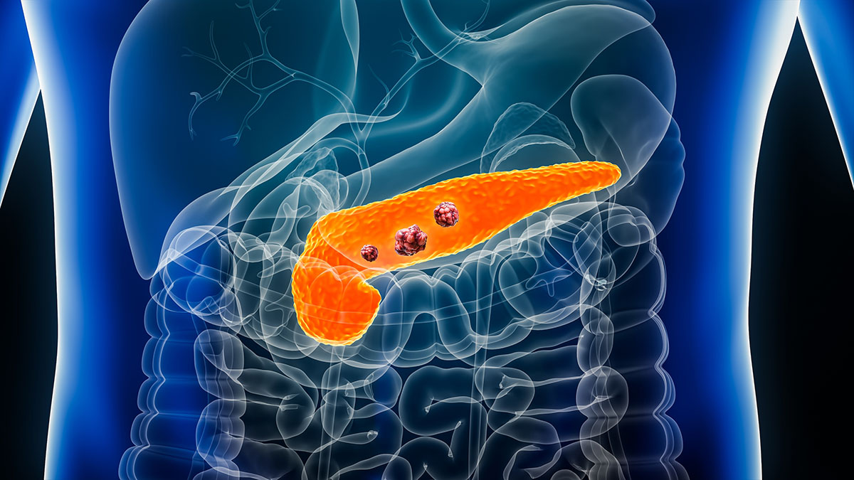 Illustration of a pancreas with tumors.