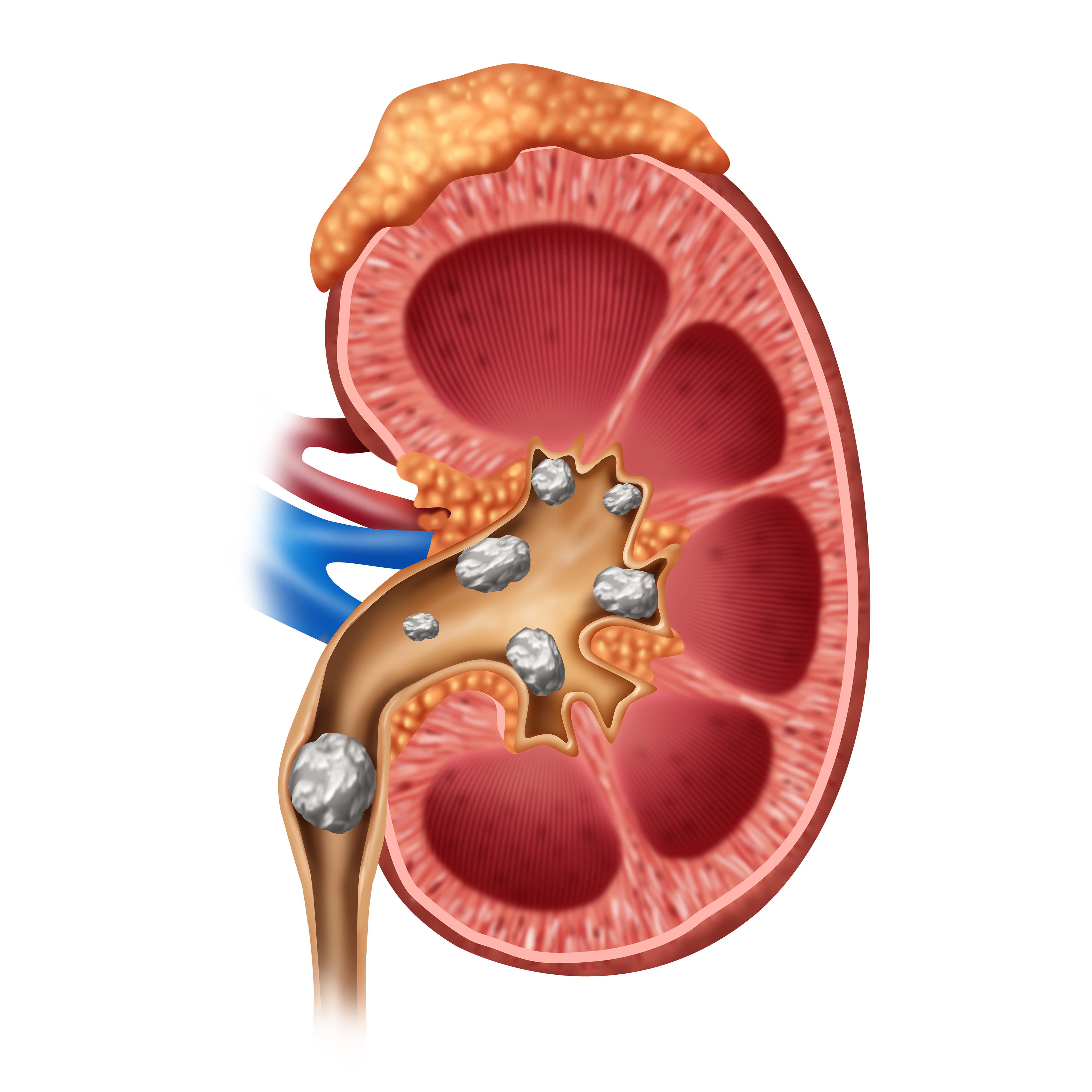 Illustration of a kidney with stones in it.