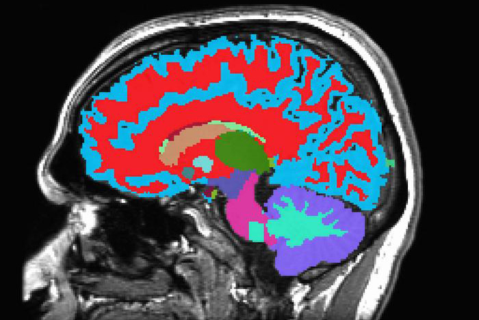 MRI image of the brain MRI image of the brain.
