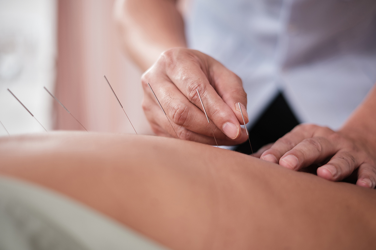 Acupuncture Relieves Chronic Low Back Pain in Older Adults