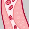 Illustration of a blood vessel with plaque buildup Illustration of a blood vessel with plaque buildup