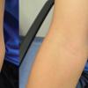 Photos of eczema on a patients elbow before and after experimental treatment