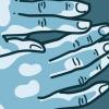 Illustration of hands with patches of vitiligo Illustration of hands with patches of vitiligo
