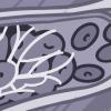 Illustration of a blood clot in a blood vessel Illustration of a blood clot in a blood vessel