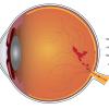 Diagram of an eye with a retinal vein occlusion Diagram of an eye with a retinal vein occlusion