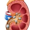Illustration of a kidney with stones in it.