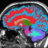 MRI image of the brain.