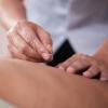 Acupuncture treatment on a person’s back.