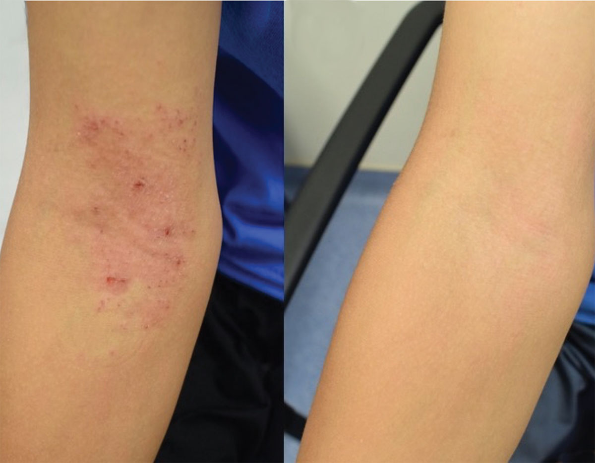 Bacteria Treatment Improves Children s Eczema NIH News In Health