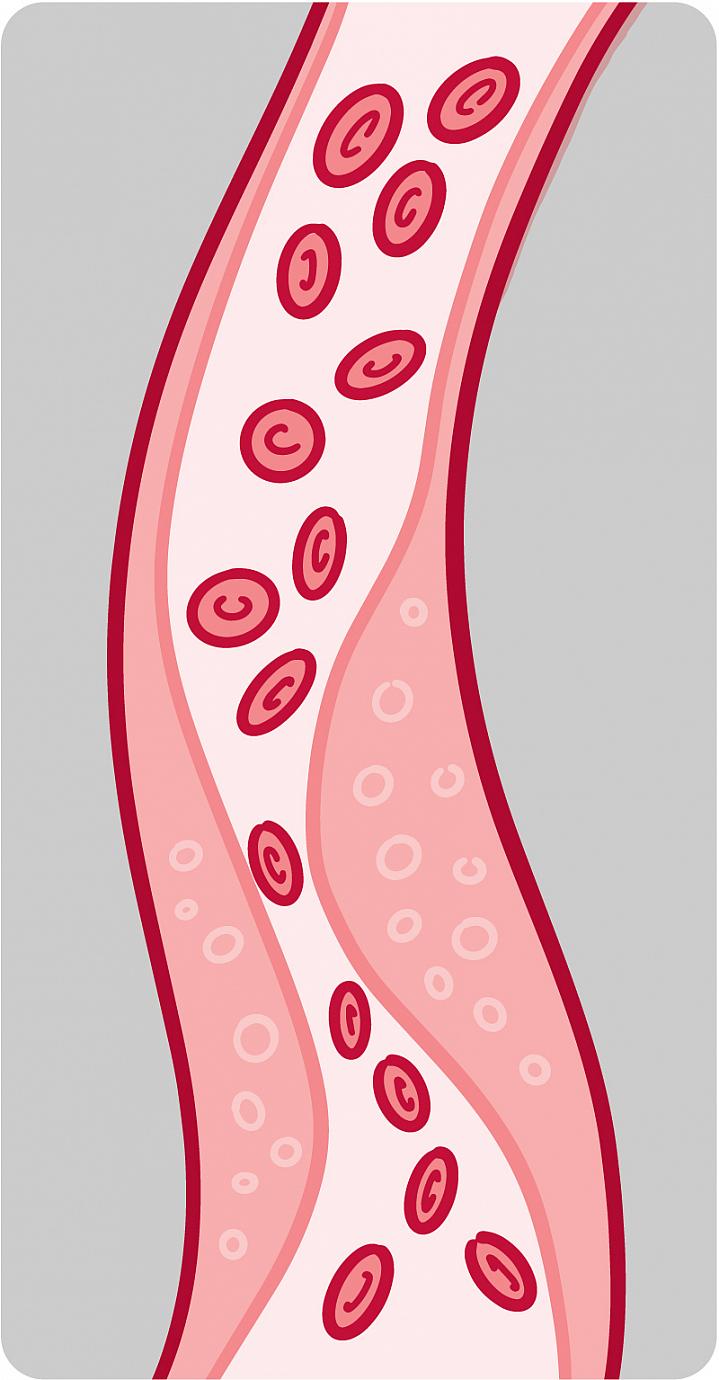 Illustration of a blood vessel with plaque buildup
