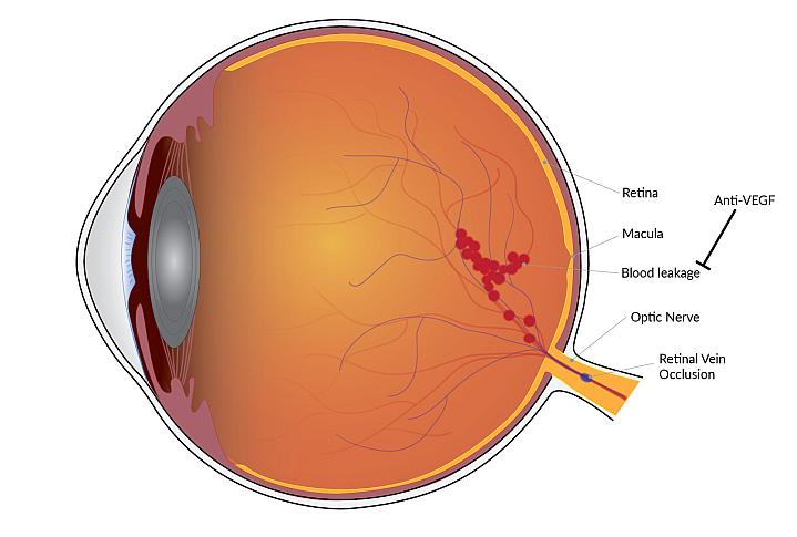 Diagram of an eye with a retinal vein occlusion