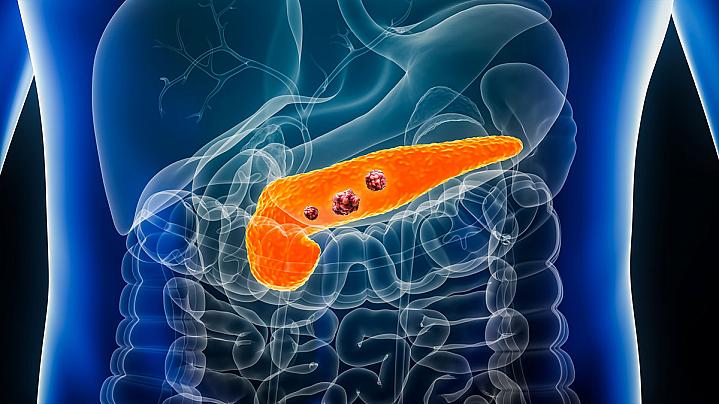 Illustration of a pancreas with tumors.